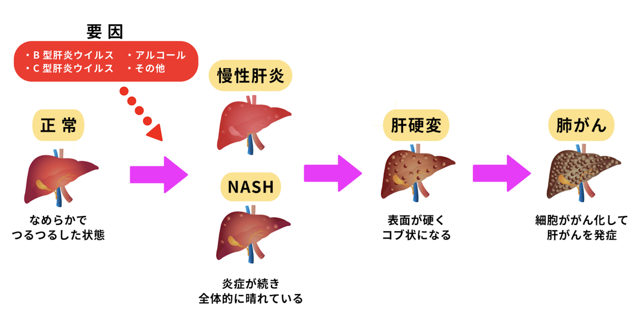 慢性肝炎